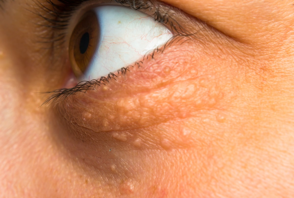 Ways to Deal With Cholesterol Deposits Around Your Eyes