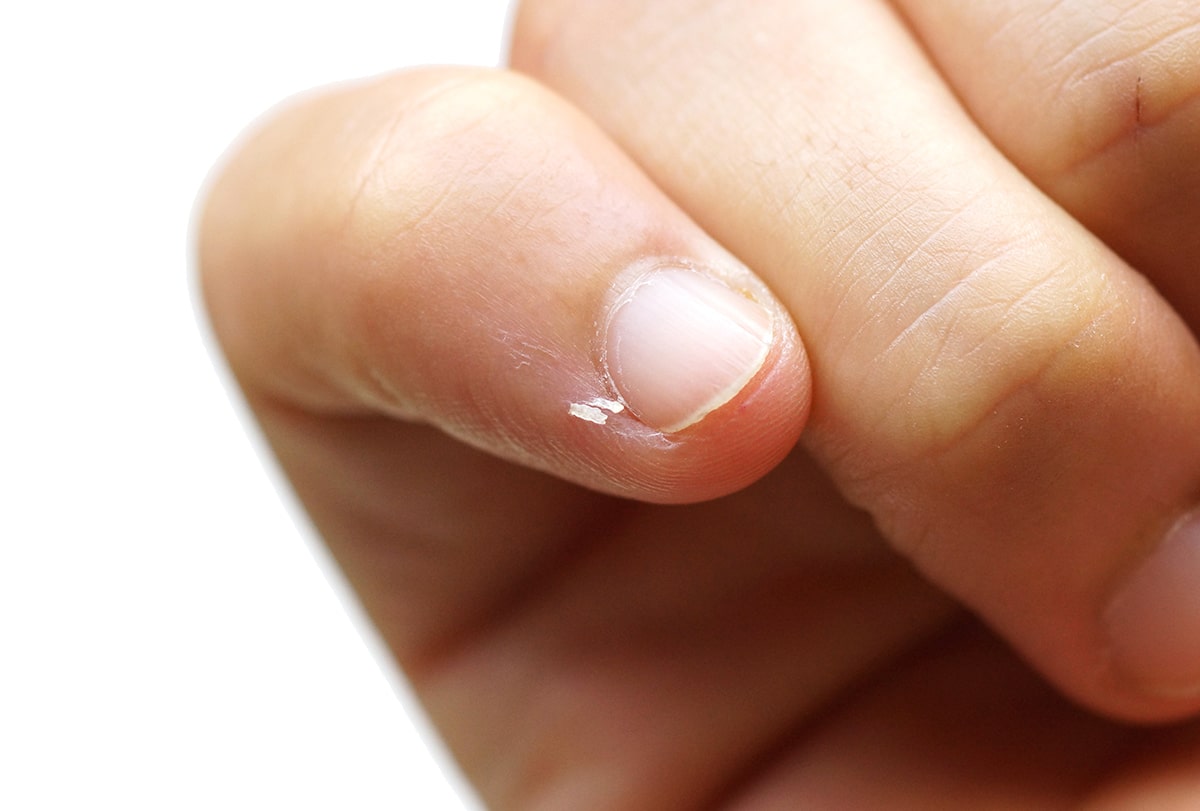 5 Home Remedies for Hangnails