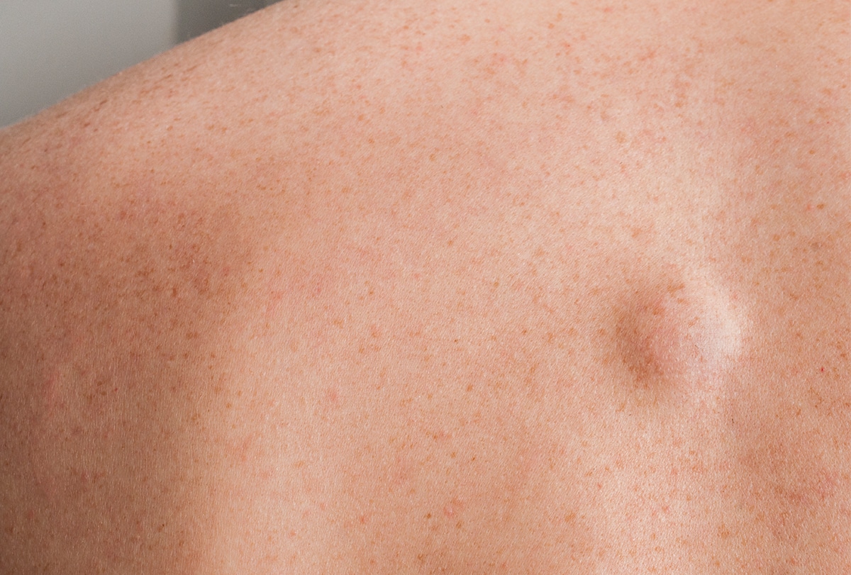 5 Home Remedies to Reduce Lipoma