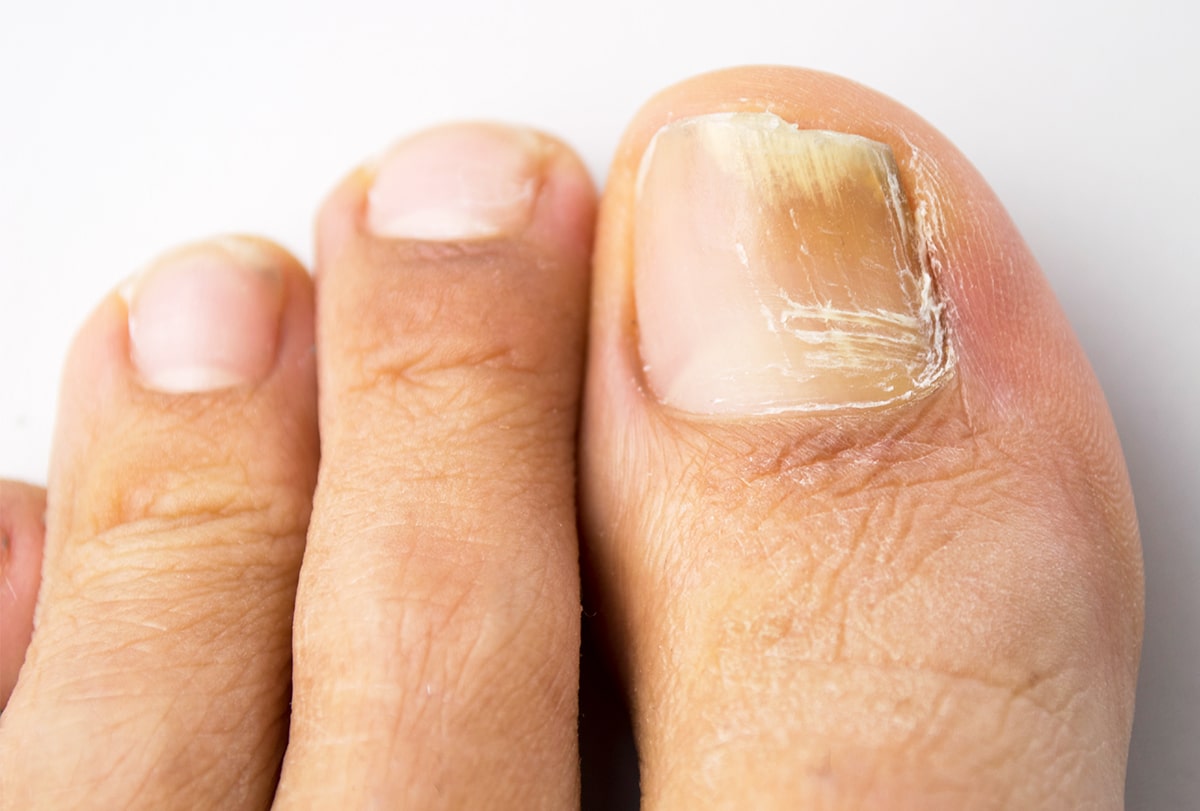 6 Home Remedies for Toenail Fungus