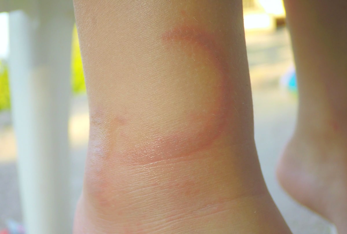 10 Home Remedies for Jellyfish Stings