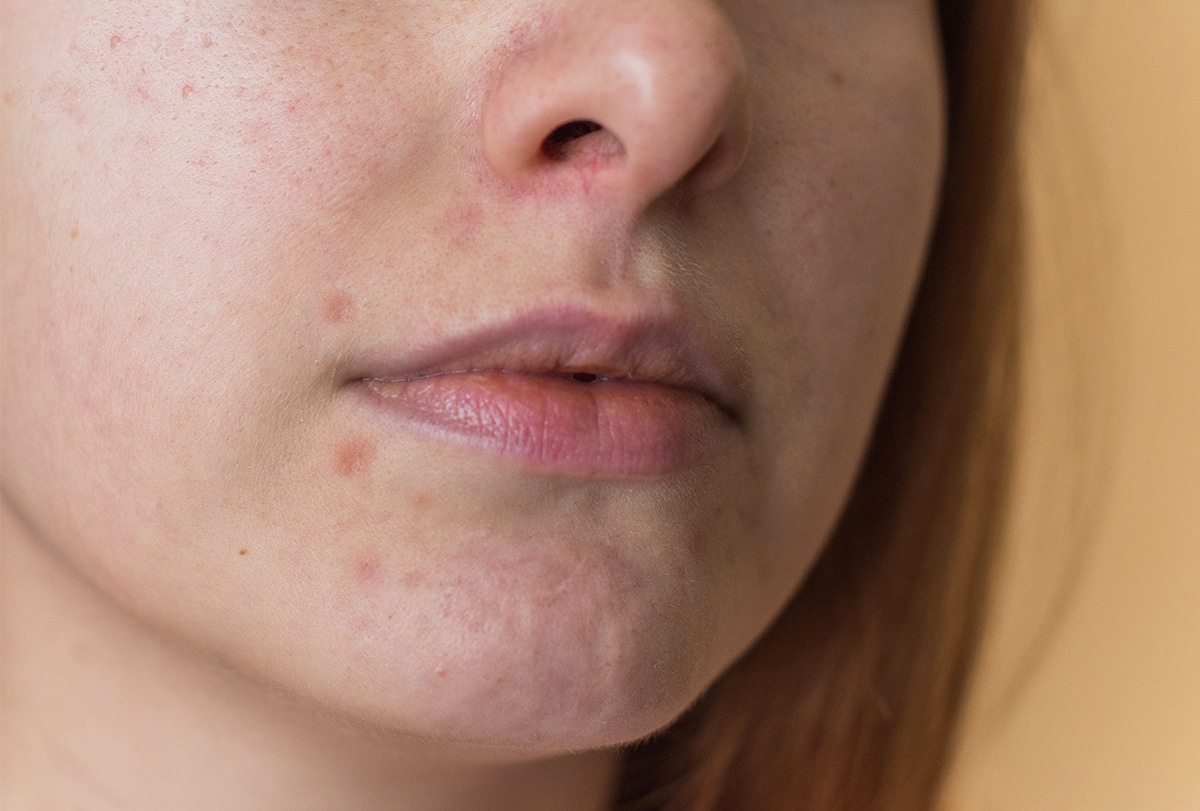 Deal with Darkish Spots Across the Mouth