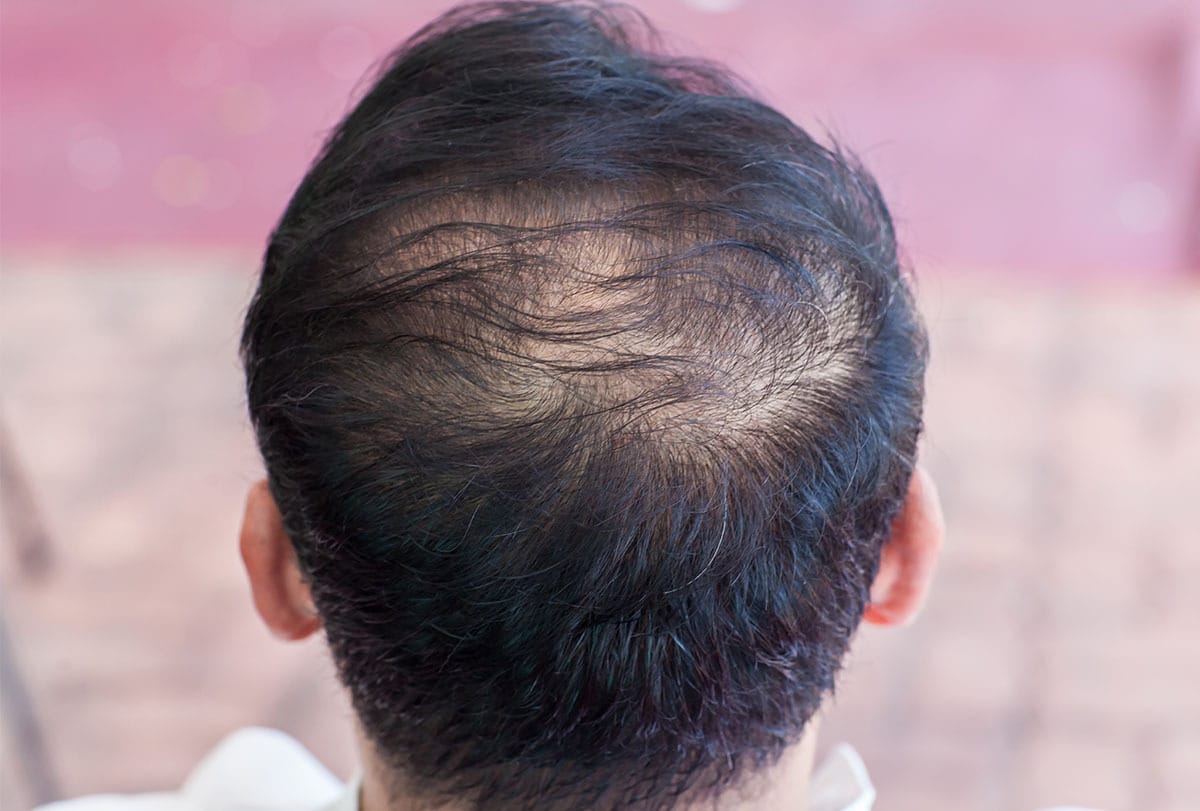 Hair Thinning: Causes, Types, and Treatment